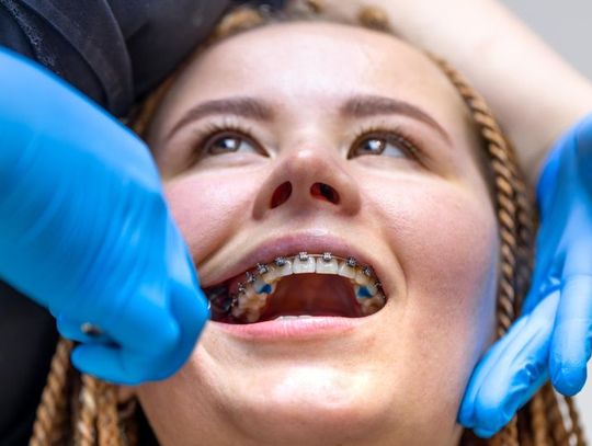 Invisalign czy aparat stały – co wybrać dla skutecznego efektu?