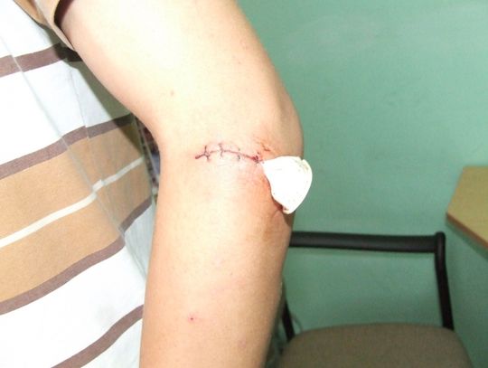 Oburzony pacjent: W ranie zaszyto mi kawałek gumy! Lekarz wykonał zabieg prawidłowo 