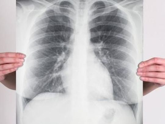 Sprawdź swoje płuca podczas darmowego badania