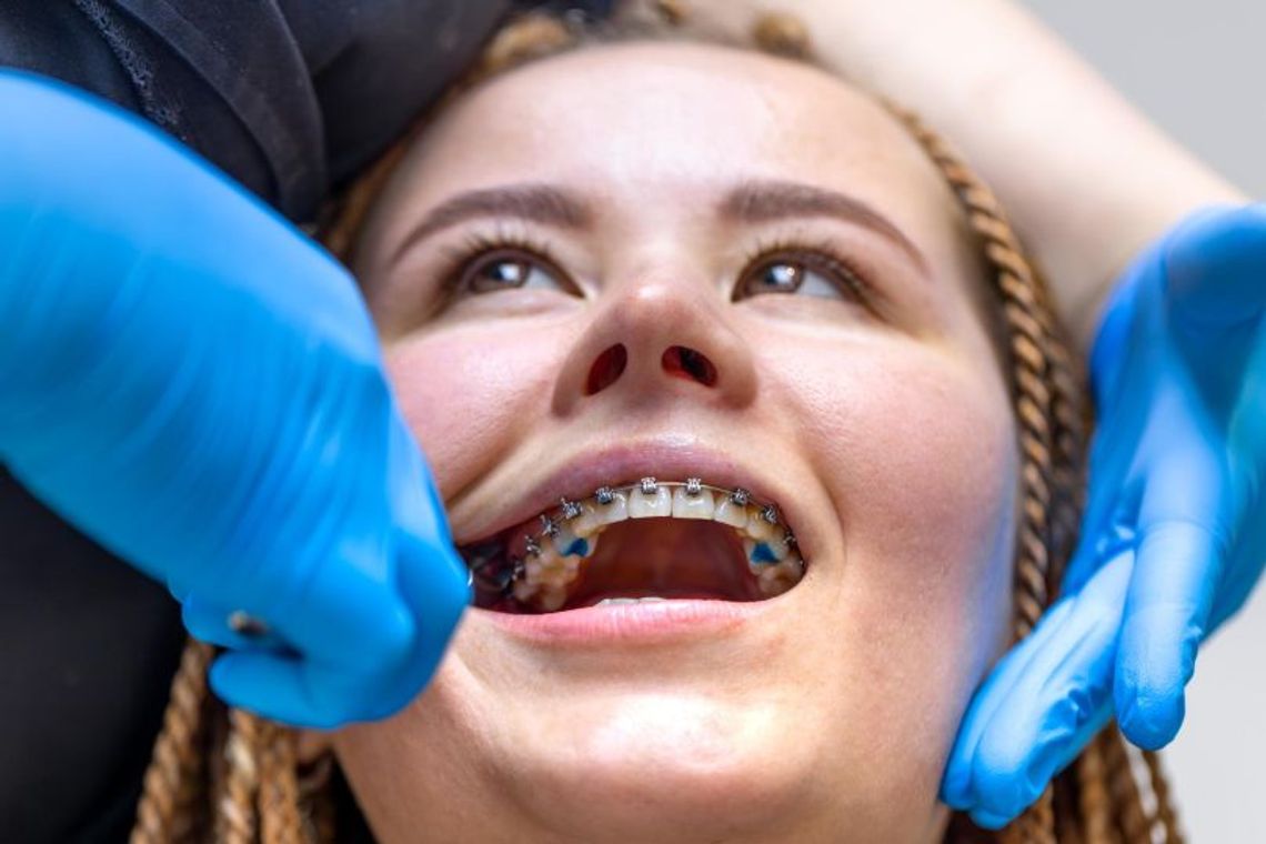 Invisalign czy aparat stały – co wybrać dla skutecznego efektu? Invisalign czy aparat stały – co wybrać dla skutecznego efektu?